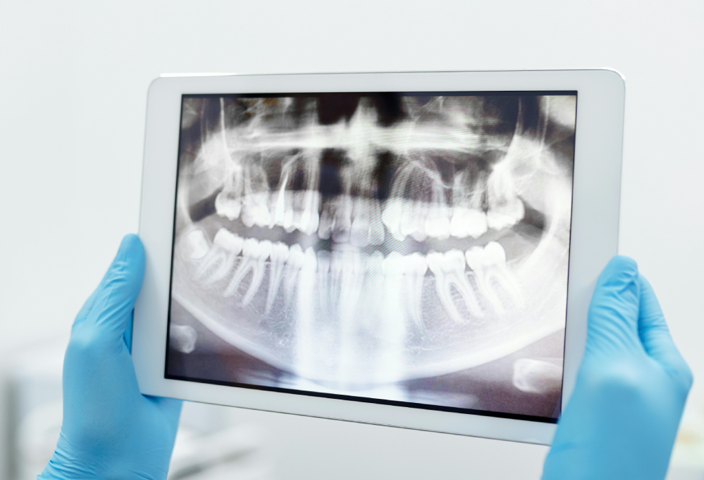 OPG (Panoramic X-ray)