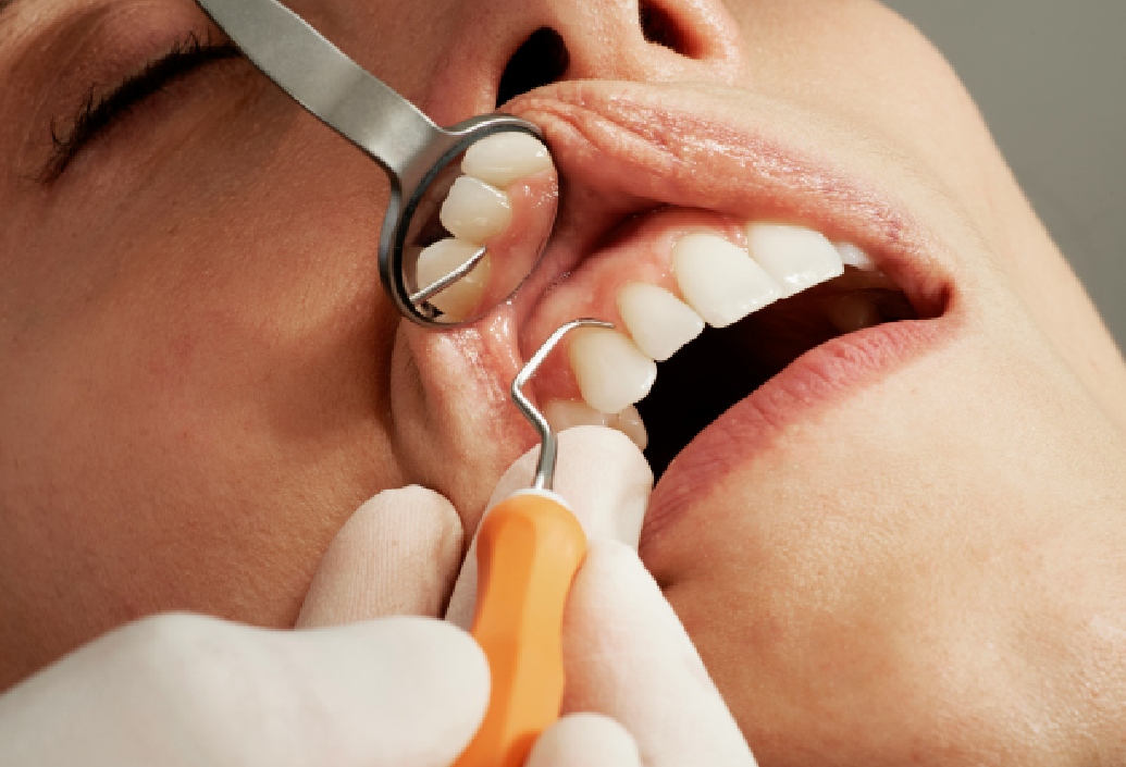 Root Canal Procedure